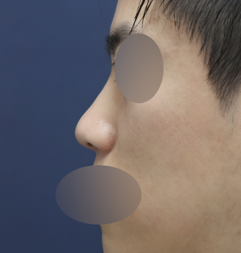 Improving Your Impression Before and After Male Rhinoplasty image 3