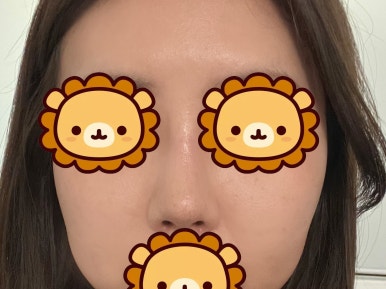 [강남성형외과 복코성형 후기] 각도 안 나오던 펑퍼짐한 코 모양.. 김준형 원장님 만나 정착했어요! 관련 이미지 8