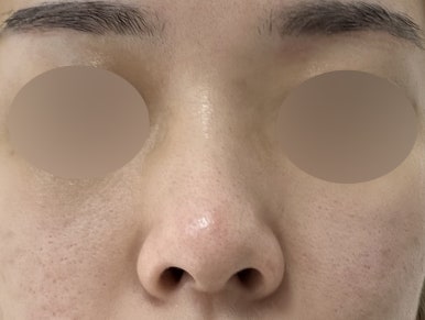[Gangnam Plastic Surgery Clinic Hump Nose Surgery Review] Worried It Might Look Unnatural, I Hesitated About My Hump Nose… Adding Bulbous Nose Correction Helped Me Settle on My Perfect Nose Line! image 4