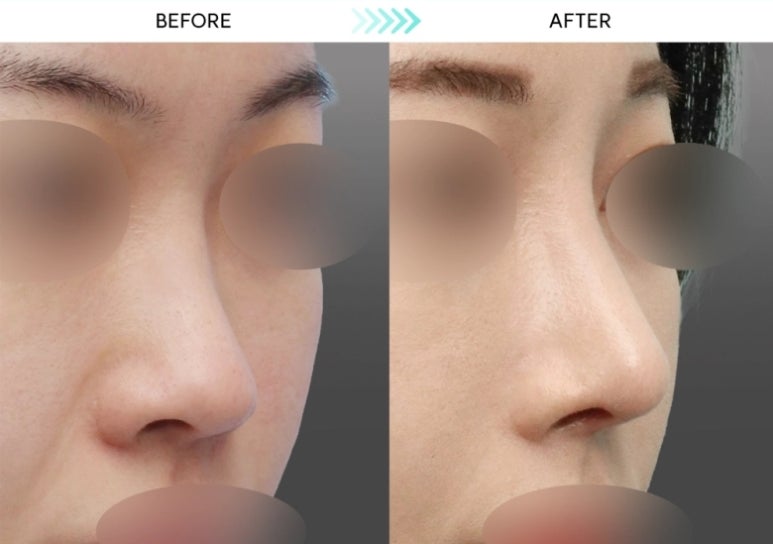 [First Rhinoplasty] Three Months After Hump Nose Correction: The Standard Approach to Nasal Tip Osteotomy and Hump Nose Correction image 2