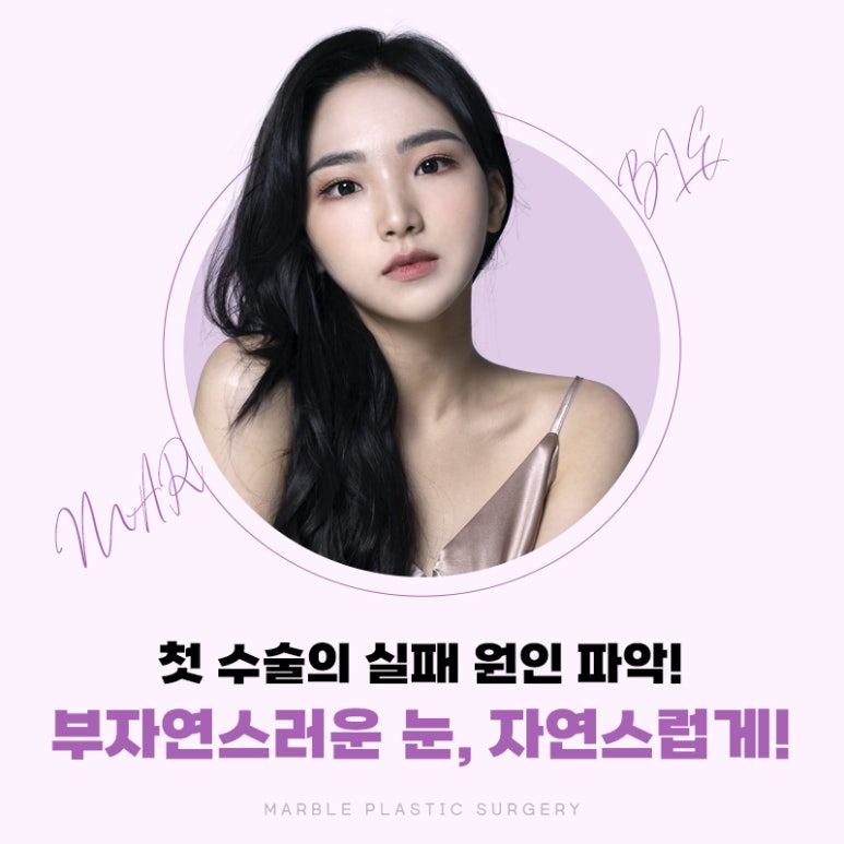 눈재수술 안정적이고 확실하게! 관련 이미지 4