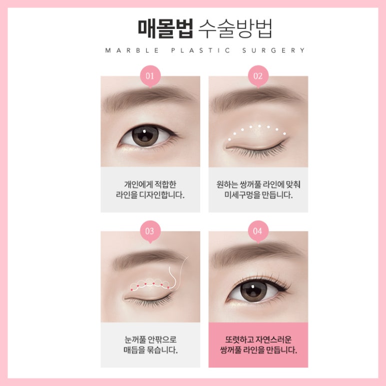 쌍꺼풀매몰후기 찾아보고 있다면 관련 이미지 5