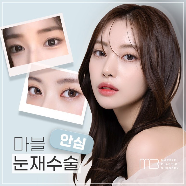 눈성형 눈재수술잘하는병원, 이렇게 준비하세요! 관련 이미지 1