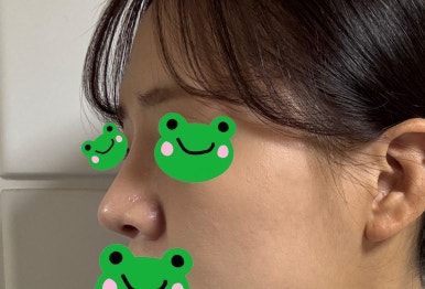 [Gangnam Plastic Surgery Rhinoplasty Review] My Short Nose Looked Upturned from the Front… Now It Has the Perfect Line with Postoperative Care Too! image 4