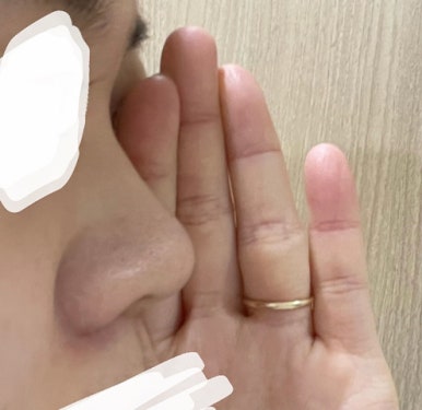 [마블성형외과 코수술 후기] 퍼진 복코에 매부리까지.. 인상 강해 보여서 거울 보기 싫었던 과거 탈출ㅠㅠ 관련 이미지 4