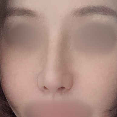 [강남역성형외과 매부리코성형 후기] 첫 수술 실패한 복코 매부리코.. 재수술로 완벽하게 성공했어요! 관련 이미지 6