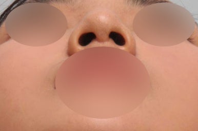보형물 없이 하는 코수술, 무보형물 코수술이 가능한 경우는? 관련 이미지 7