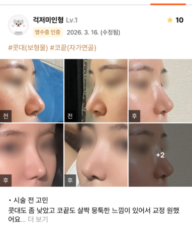 [마블성형외과 코성형 후기] 코수술 한 티도 안 나던 뭉툭한 복코... 재수술로 드디어 정착했어요ㅠㅠ 관련 이미지 1