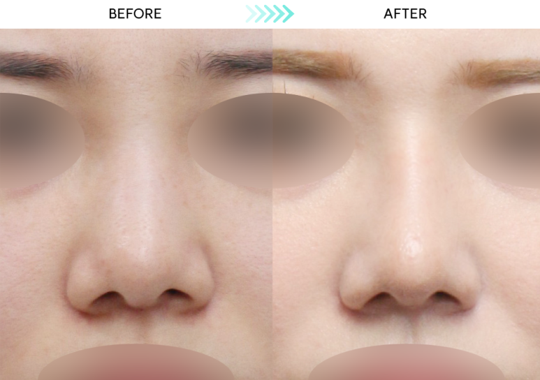 [Revision Rhinoplasty] 5 Months After Short Nose Correction: The Standard Approach to Bulbous Nose Correction and Alar Reduction image 3