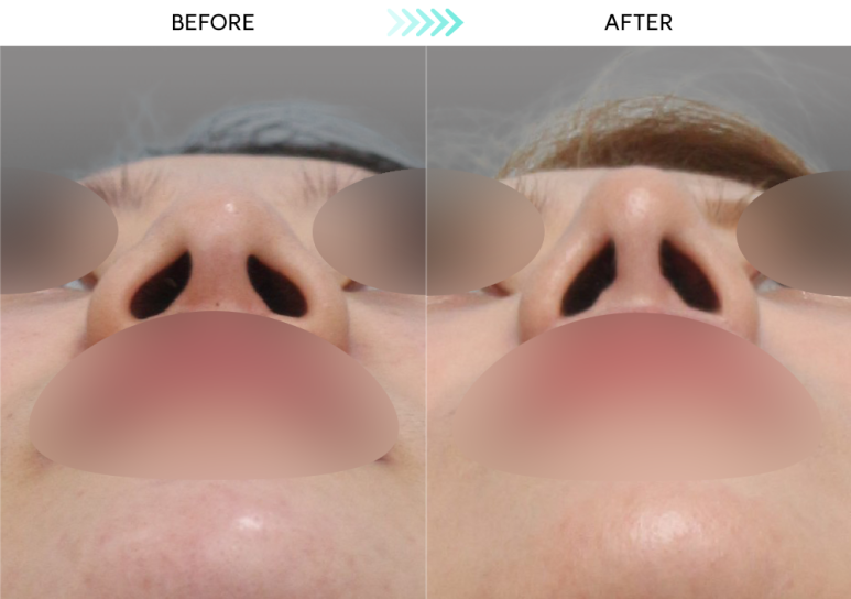 [Revision Rhinoplasty] 5 Months After Short Nose Correction: The Standard Approach to Bulbous Nose Correction and Alar Reduction image 6