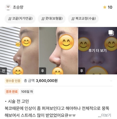 [강남역성형외과 복코성형 후기] 지인들도 부러워하는 매끄러운 코라인, 원장님 덕에 거울 볼 때마다 뿌듯해요 관련 이미지 1