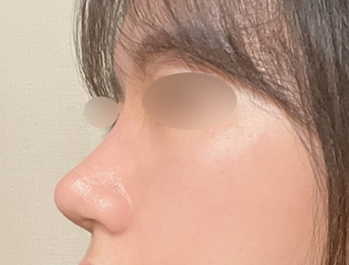 [Gangnam Station Plastic Surgery Clinic Bulbous Nose Rhinoplasty Review] My nose used to spread when I smiled and caused me stress... Now I’ve found the nose of my dreams! Haha image 5