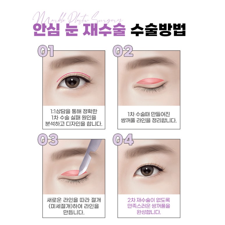 눈재수술 안정적이고 확실하게! 관련 이미지 3