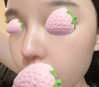 [강남성형외과 코재수술 후기] 무너졌던 코 기둥..ㅠㅠ 반년 발품 고생 끝에 인생 옆라인 찾았어요! 관련 이미지 4