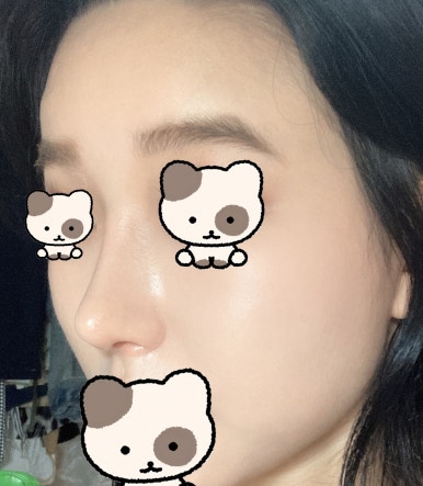 [Gangnam Station Plastic Surgery Hump Nose Surgery Review] I Escaped the Hump That Fillers Couldn’t Fix! It Looks Prettier with a Slim, Straight Line Haha image 6