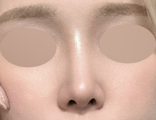 [Gangnam Plastic Surgery Clinic Hump Nose Surgery Review] Worried It Might Look Unnatural, I Hesitated About My Hump Nose… Adding Bulbous Nose Correction Helped Me Settle on My Perfect Nose Line! image 6