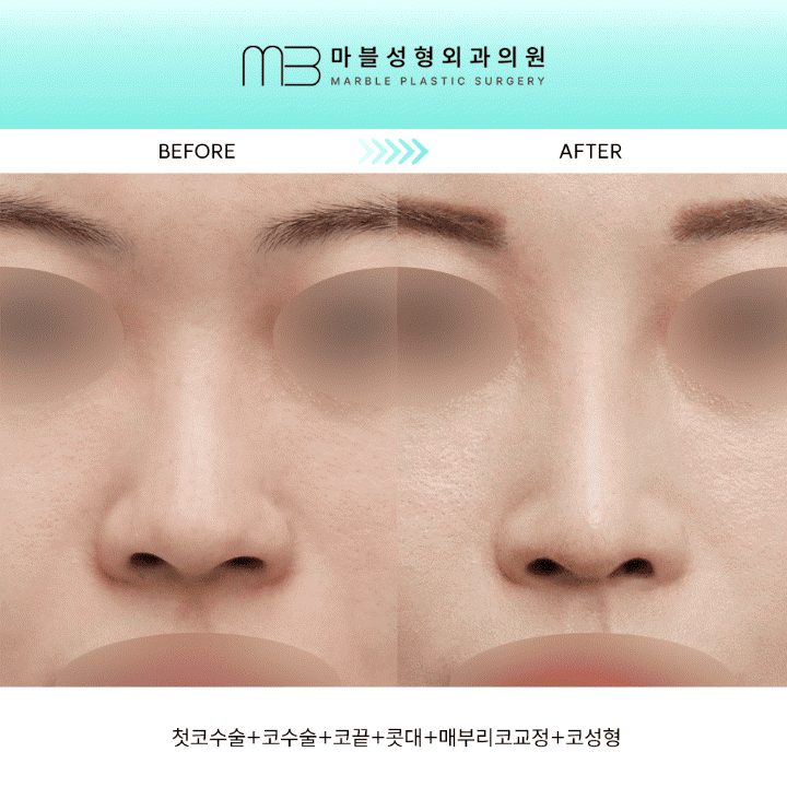 [First Rhinoplasty] Three Months After Hump Nose Correction: The Standard Approach to Nasal Tip Osteotomy and Hump Nose Correction image 1