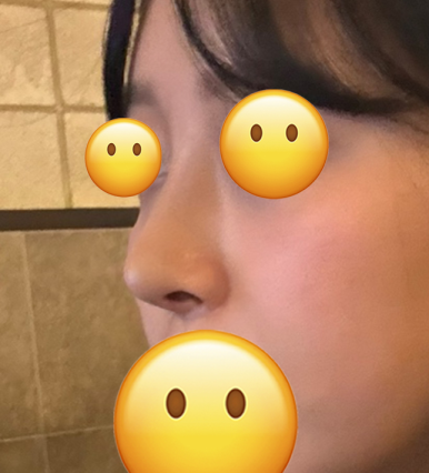 [Bulbous Nose Surgery Review] Solved My Plain Bulbous Nose Concerns! I Got a More Defined Nasal Bridge and a Better Impression! image 9