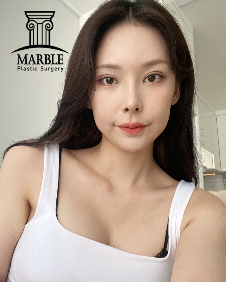눈밑지방재배치, 뚜렷한 인상을 주기 위해 마블성형외과의원 관련 이미지 7