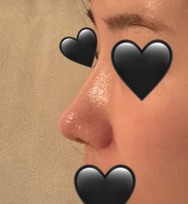 [Gangnam Plastic Surgery Rhinoplasty Review] I Was Worried About My Bulbous Nose.. It Turned Out Beautiful While Healing Well Without Inflammation or Side Effects hehe image 6