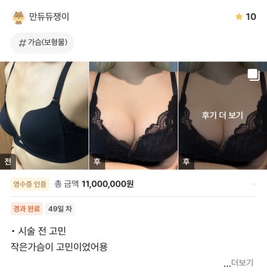 [Gangnam Station Plastic Surgery Clinic Breast Augmentation Review] My Sparse, Uneven Breasts... I Finally Fulfilled My Wish Without Visible Armpit Incision Scars Haha image 1