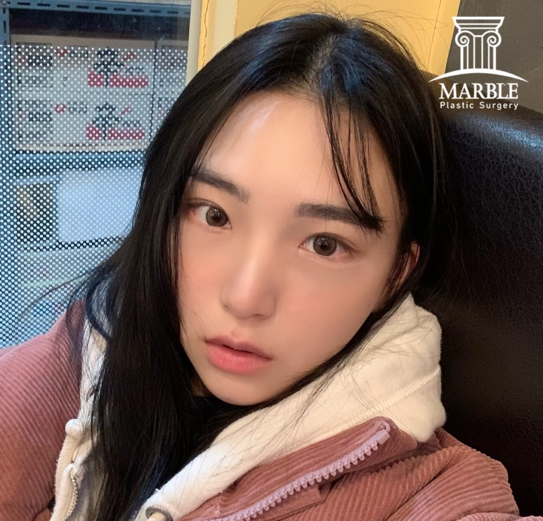 눈매교정 해야 하는 눈일까? 마블성형외과의원에서 알아보자! 관련 이미지 7