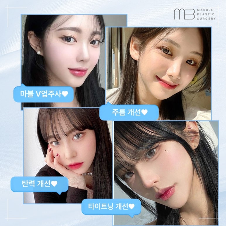 V-Up Injection That Really Showed Results Before and After Contouring Injections | Recommended by Sinnonhyeon Plastic Surgery Clinic | Marble Plastic Surgery Clinic image 12