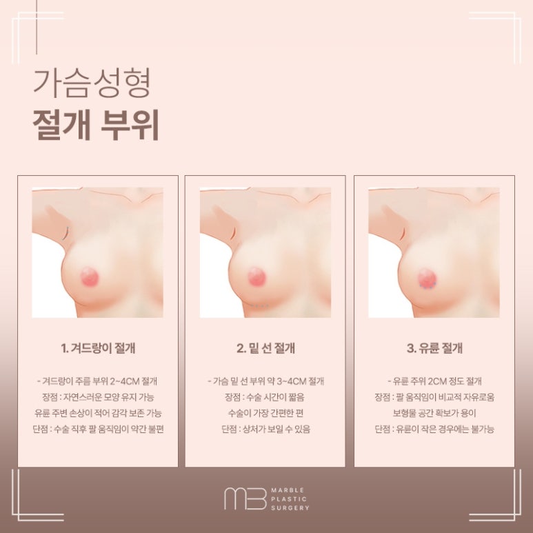 가슴성형흉터 절개 위치별 특징 비교｜마블성형외과 관련 이미지 5