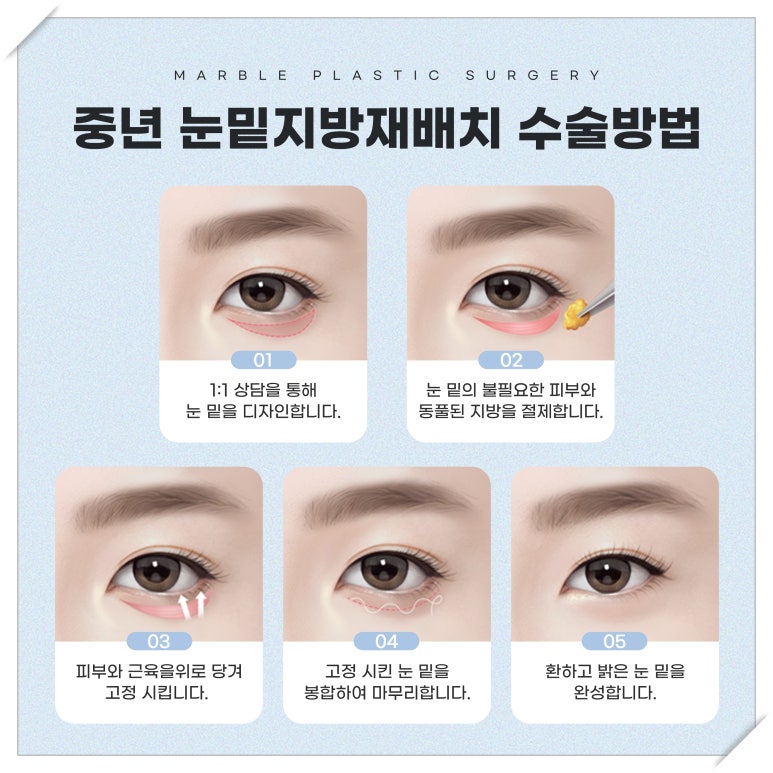 나이 들면 눈 밑이 꺼진다? 중년눈밑지방재배치로 어려 보이는 법 (feat. 마블성형외과의원 서용훈원장) 관련 이미지 4