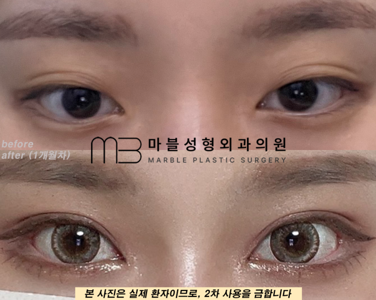 자연유착쌍꺼풀후기 눈매를 더욱 또렷하게 관련 이미지 6
