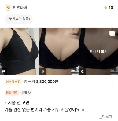 [강남역 성형외과 가슴수술 리얼후기] 윗가슴 실종됐던 빈약한 체형..겨절로 감쪽같이 예뻐져서 행복해요ㅎㅎ 관련 이미지 1