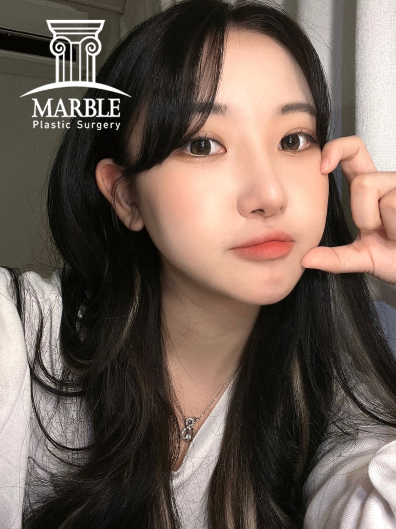 쌍꺼풀수술비용, 합리적인 변화는 마블성형외과의원! 관련 이미지 1