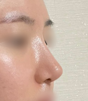 [마블성형외과 코성형 후기] 코수술 한 티도 안 나던 뭉툭한 복코... 재수술로 드디어 정착했어요ㅠㅠ 관련 이미지 7