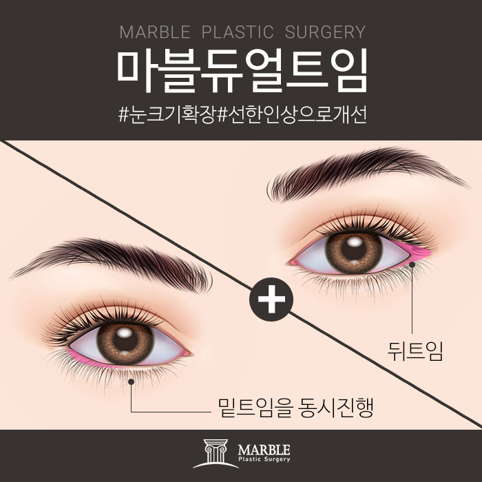 뒷트임밑트임후기 크고 또렷한 눈으로 관련 이미지 6