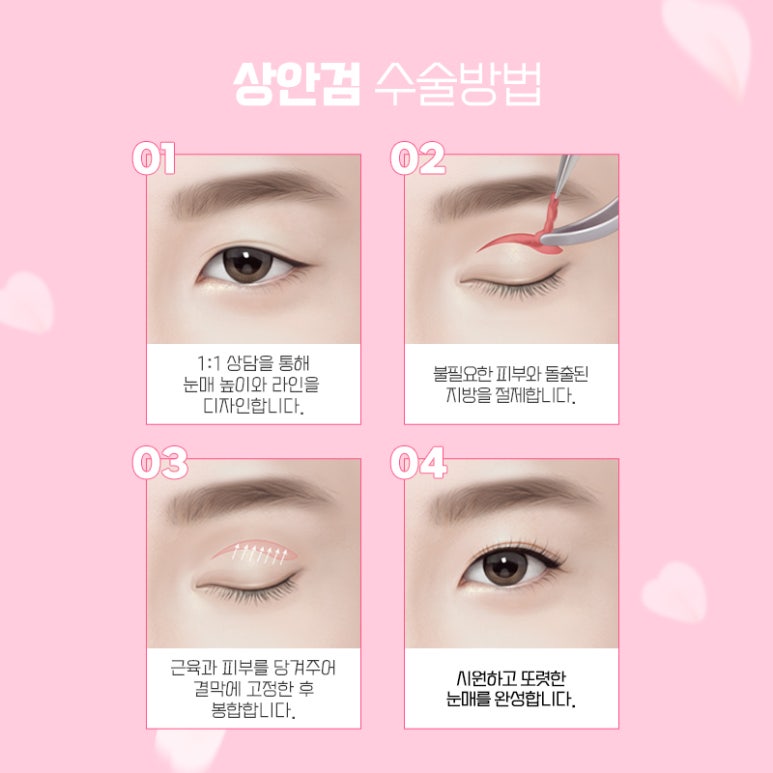 상안검수술비용 따지기 전에 확인하자 관련 이미지 5