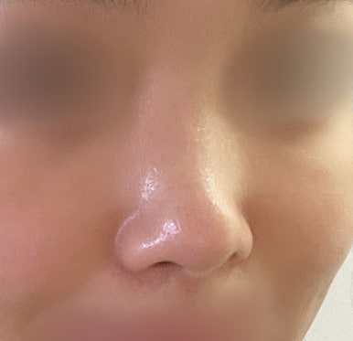 [Gangnam Plastic Surgery Clinic Rhinoplasty Revision Review] No matter how many surgeries I had, my nose still looked flat and wide... Now it has finally settled into a beautiful shape haha image 3