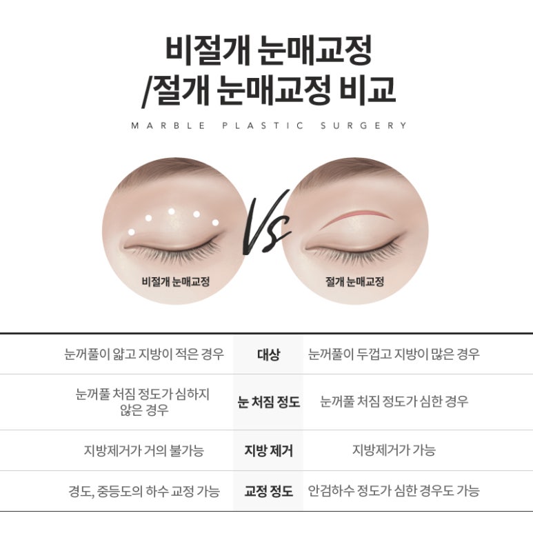 눈매교정 부작용 무엇이 있을까? 관련 이미지 8
