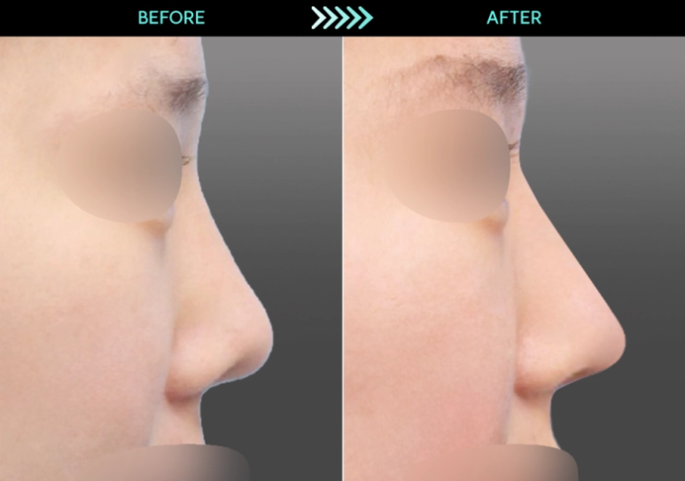 [Revision Rhinoplasty] 2 Months After Bulbous Nose Correction: The Standard Approach to Bulbous Nose and Short Nose Correction image 5