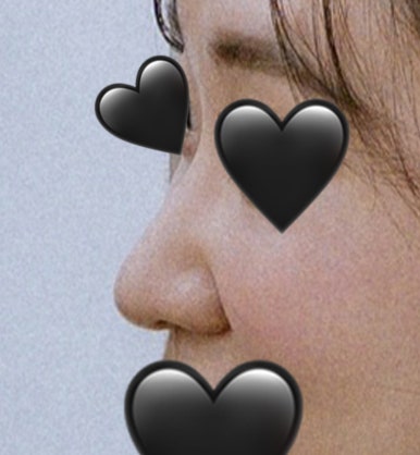 [Gangnam Plastic Surgery Rhinoplasty Review] I Was Worried About My Bulbous Nose.. It Turned Out Beautiful While Healing Well Without Inflammation or Side Effects hehe image 3