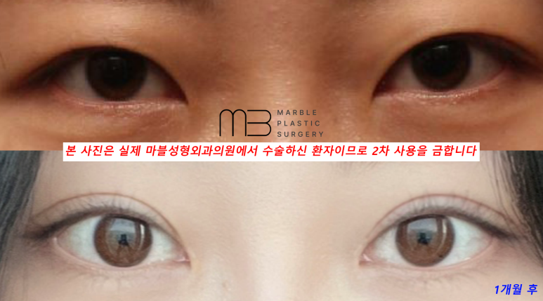 눈재수술 잘 알아봐야 관련 이미지 5