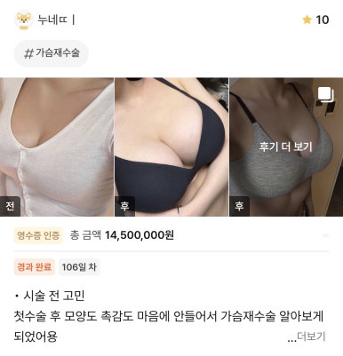 [Gangnam Plastic Surgery Breast Surgery Review] I Didn’t Like the Shape or Feel of My Breasts... My Revision Surgery with Mentor Extra Was a Success, Haha image 1