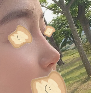[Gangnam Station Plastic Surgery Nose Revision Review] A Tearful 4th Revision Marked by Failure... I Met Dr. Kim Jun-hyung and Succeeded! image 5