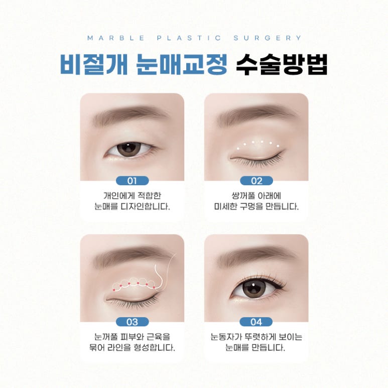 강남눈매교정 더 또렷하게 마블성형외과의원 관련 이미지 6