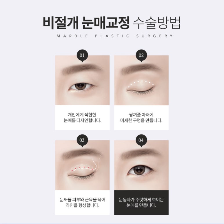 눈매교정 부작용 무엇이 있을까? 관련 이미지 6