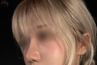 [Gangnam Plastic Surgery Hump Nose Surgery Review] The Bulky, Humped Nose That Looked Thick... A Refined Impression Achieved Without an Implant, haha image 7