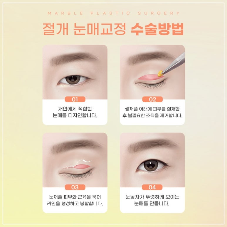 강남역 고등학생눈매교정잘하는곳, 시술방법, 장점, 필요성 관련 이미지 7