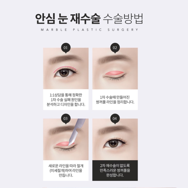 쌍꺼풀재수술 알아보고 반복하지말자 관련 이미지 4