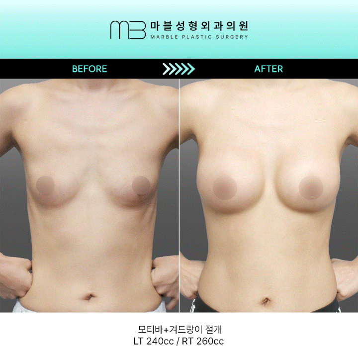 [모티바 가슴성형] 가슴확대수술 3개월 차: 모티바로 타고난 듯 자연스러운 라인의 정석 관련 이미지 1