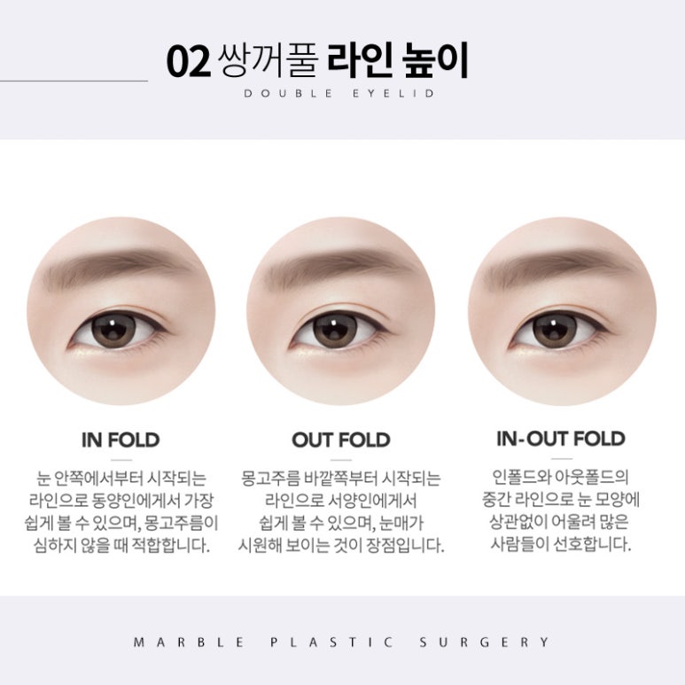 쌍수풀림 처음부터 신중하게 하면 걱정 없이 관련 이미지 5