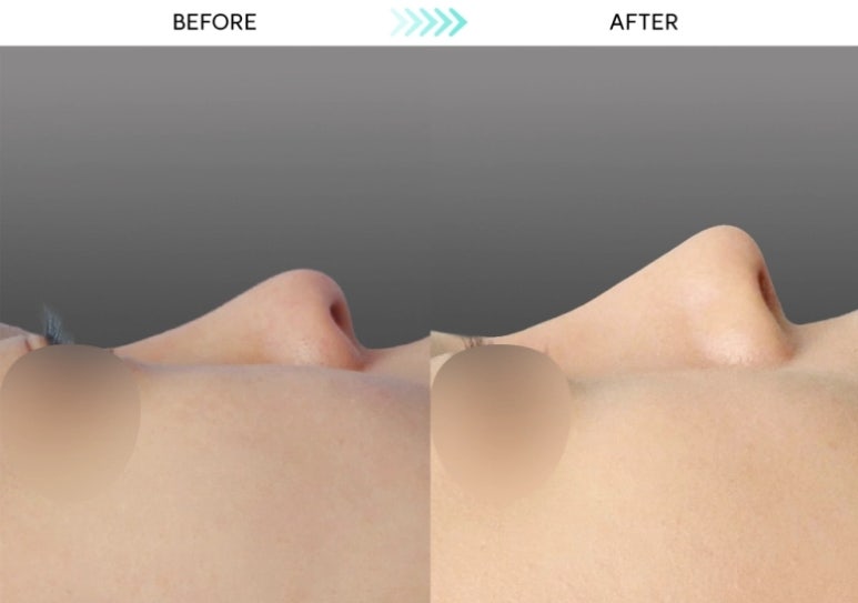 [First Rhinoplasty] Three Months After Hump Nose Correction: The Standard Approach to Nasal Tip Osteotomy and Hump Nose Correction image 4